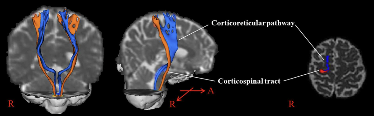 Przebieg drogi korowo-siatkowej (niebieski) oraz korowo-rdzeniowej (czerwony) w strukturach mózgowia