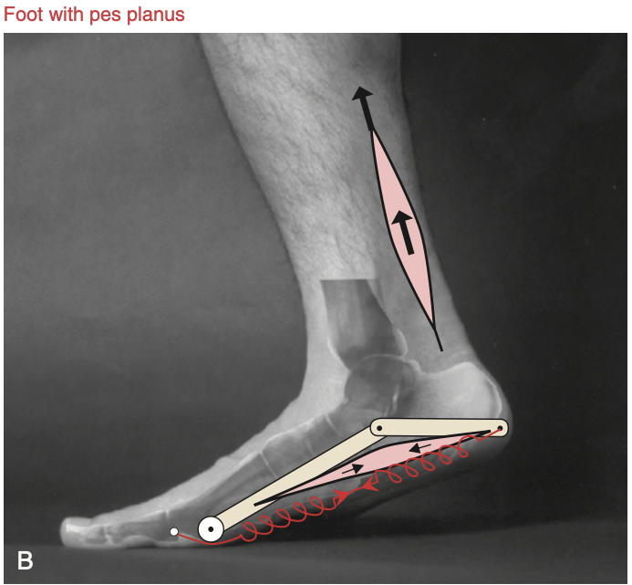 Wspięcie na palce przy niewydolnych elementach PAN (stopa płaska)