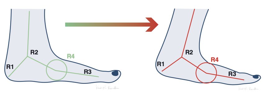 Przełamanie śródstopia