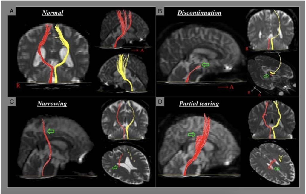 Badanie DTT drogi korowo-siatkowej.