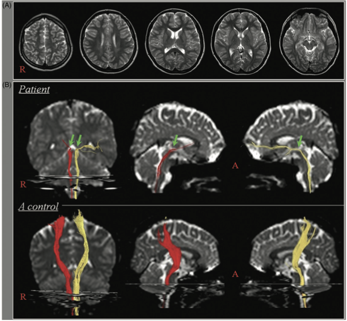 Rezonans magnetyczny mózgu